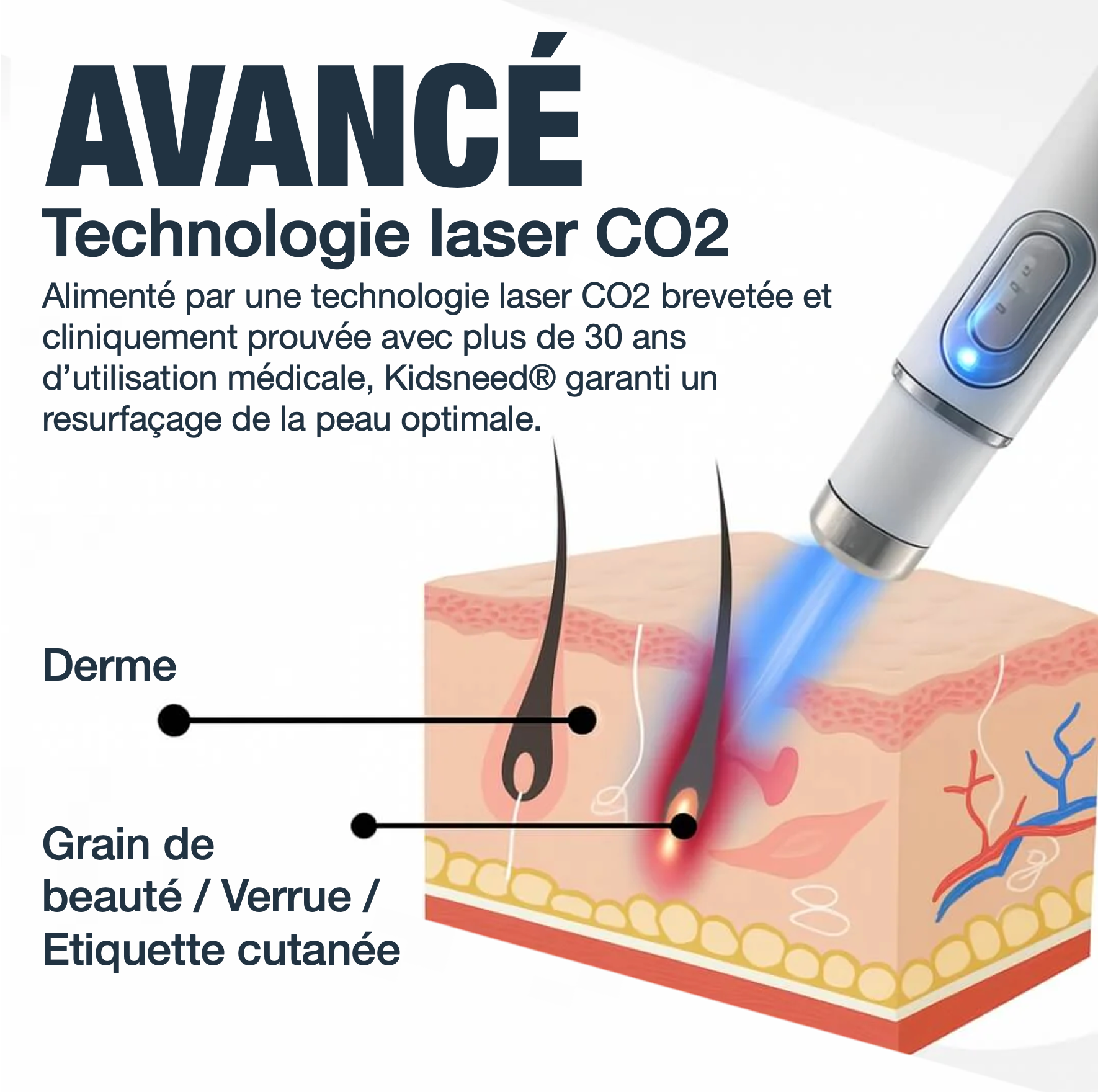 Kidsneed® Stylo Laser anti-imperfection