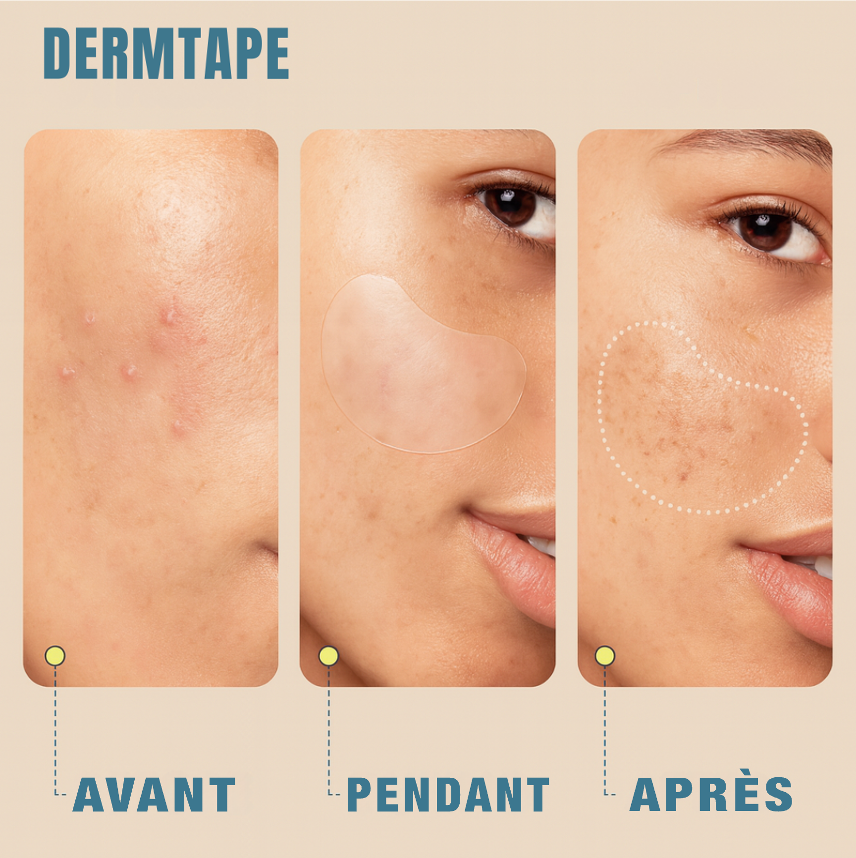 DERMTAPE® - Patch hydrocolloïde anti-acné en rouleau